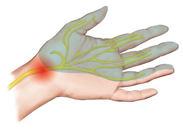 A graphic showing the affected part of the wrist when you have Carpal Tunnel Syndrome